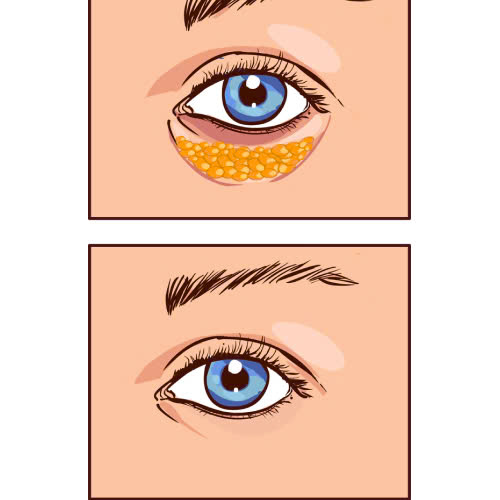 cay-mo-mi-mat-cuoi-co-de-lai-seo-khong-cung-tim-hieu-chi-tiet-ve-muc-do-an-toan-va-kha-nang-de-lai-seo-sau-khi-thuc-hien