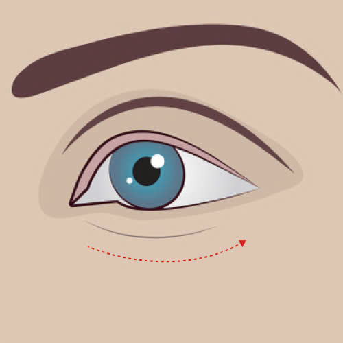 cay-mo-mi-mat-cuoi-co-nguy-hiem-khong-nhung-rui-ro-tiem-an-va-loi-khuyen-de-cay-mo-an-toan