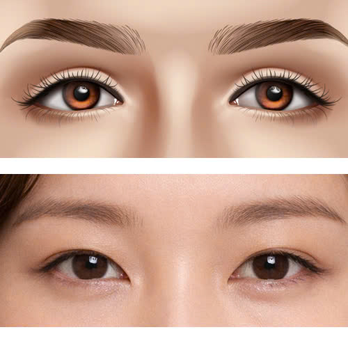 cay-mo-mi-mat-cuoi-co-tai-lom-khong-huong-dan-cham-soc-sau-khi-cay-mo-de-han-che-tai-lom