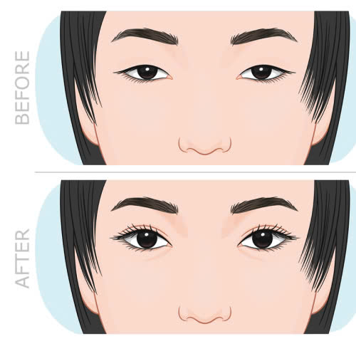 cay-mo-mi-mat-cuoi-ket-hop-cat-mi-giai-phap-tre-hoa-toan-dien-cho-doi-mat-tuoi-tre