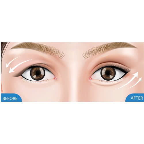 cay-mo-mi-mat-cuoi-ket-hop-cat-mi-giai-phap-tre-hoa-toan-dien-cho-doi-mat-tuoi-tre