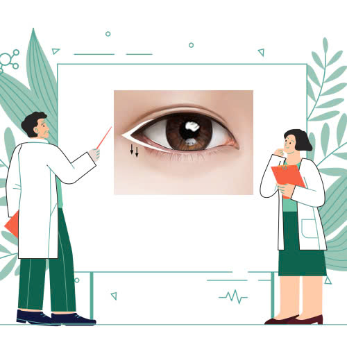 co-nen-ha-xech-mat-khong-goc-nhin-toan-dien-truoc-khi-quyet-dinh-lam-dep