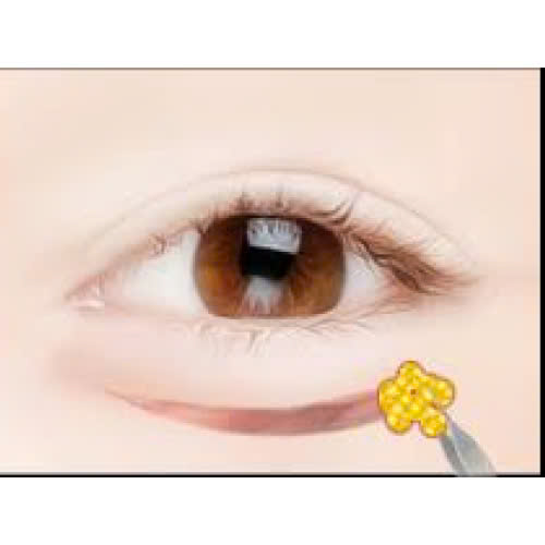 dia-chi-cay-mo-mi-mat-cuoi-uy-tin-cung-tim-hieu-nhung-luu-y-quan-trong-truoc-khi-thuc-hien