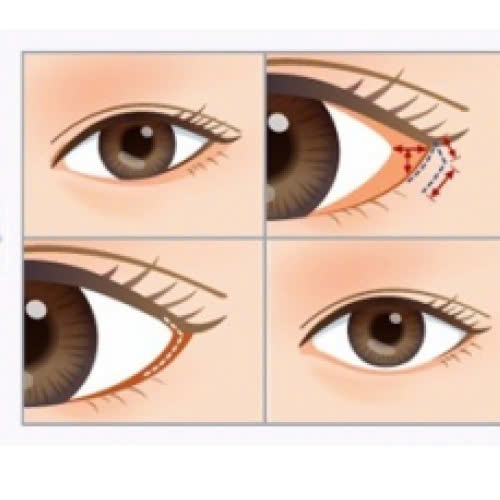 ha-xech-mat-bao-lau-thi-on-dinh-cac-giai-doan-hoi-phuc-ban-can-biet-truoc-khi-thuc-hien