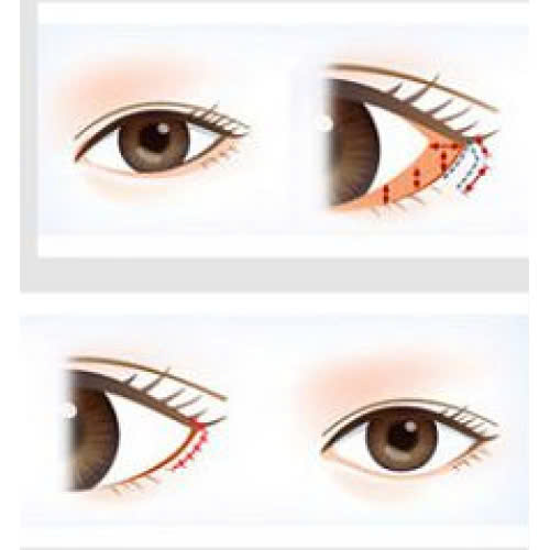 ha-xech-mat-co-dau-khong-bao-lau-thi-se-on-dinh