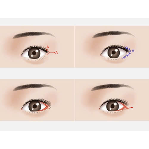 ha-xech-mat-ket-hop-mo-goc-mat-co-thuc-su-thay-doi-dien-mao-cua-ban