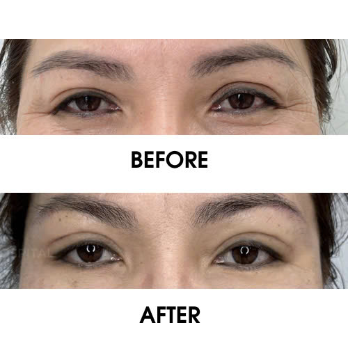 so-sanh-hinh-anh-truoc-sau-cang-chi-xoa-nhan-duoi-mat-hieu-qua-cua-phuong-phap-nay-co-nhu-mong-doi