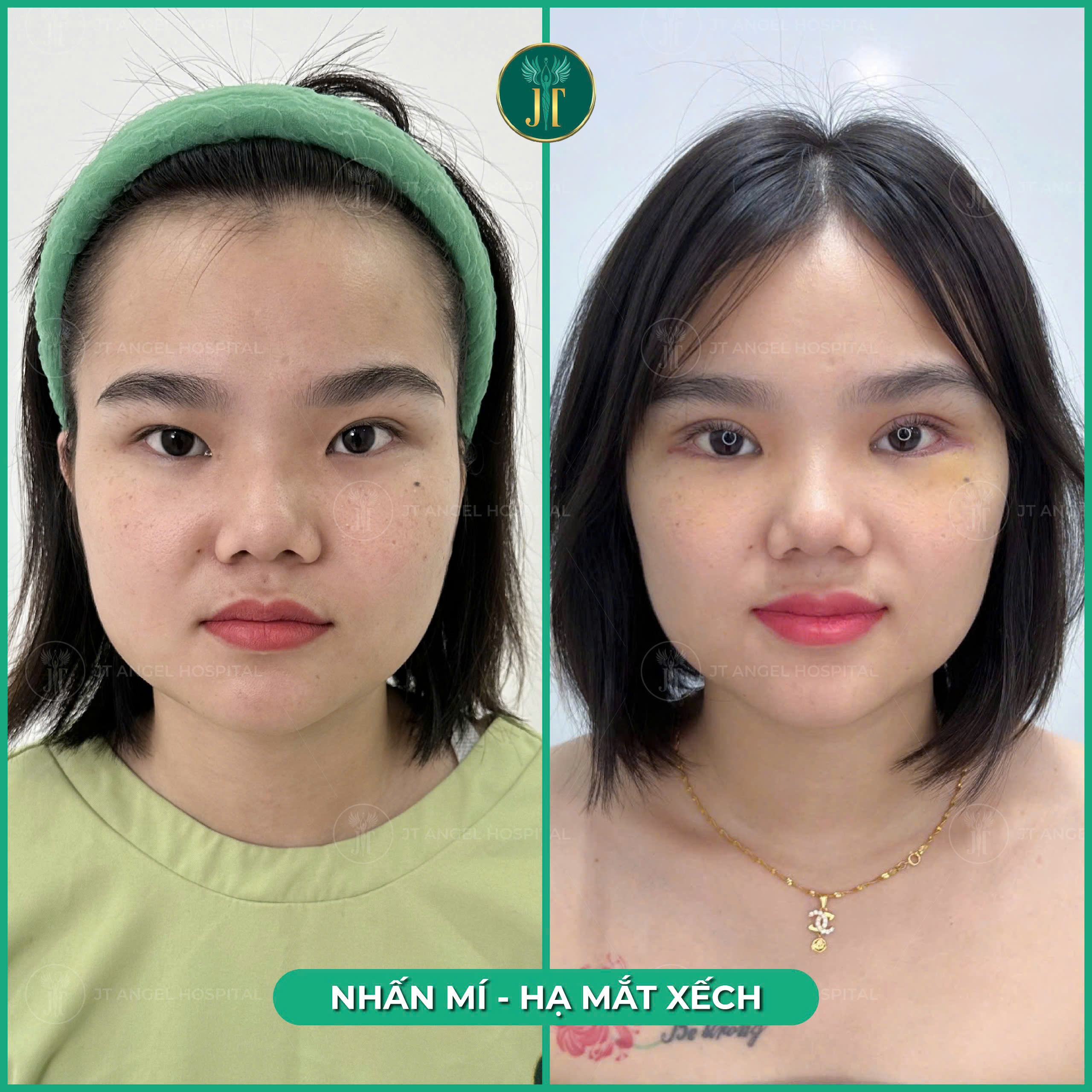 hinh-anh-truoc-sau-ha-xech-mat-su-thay-doi-than-thai-chi-sau-mot-ca-tieu-phau