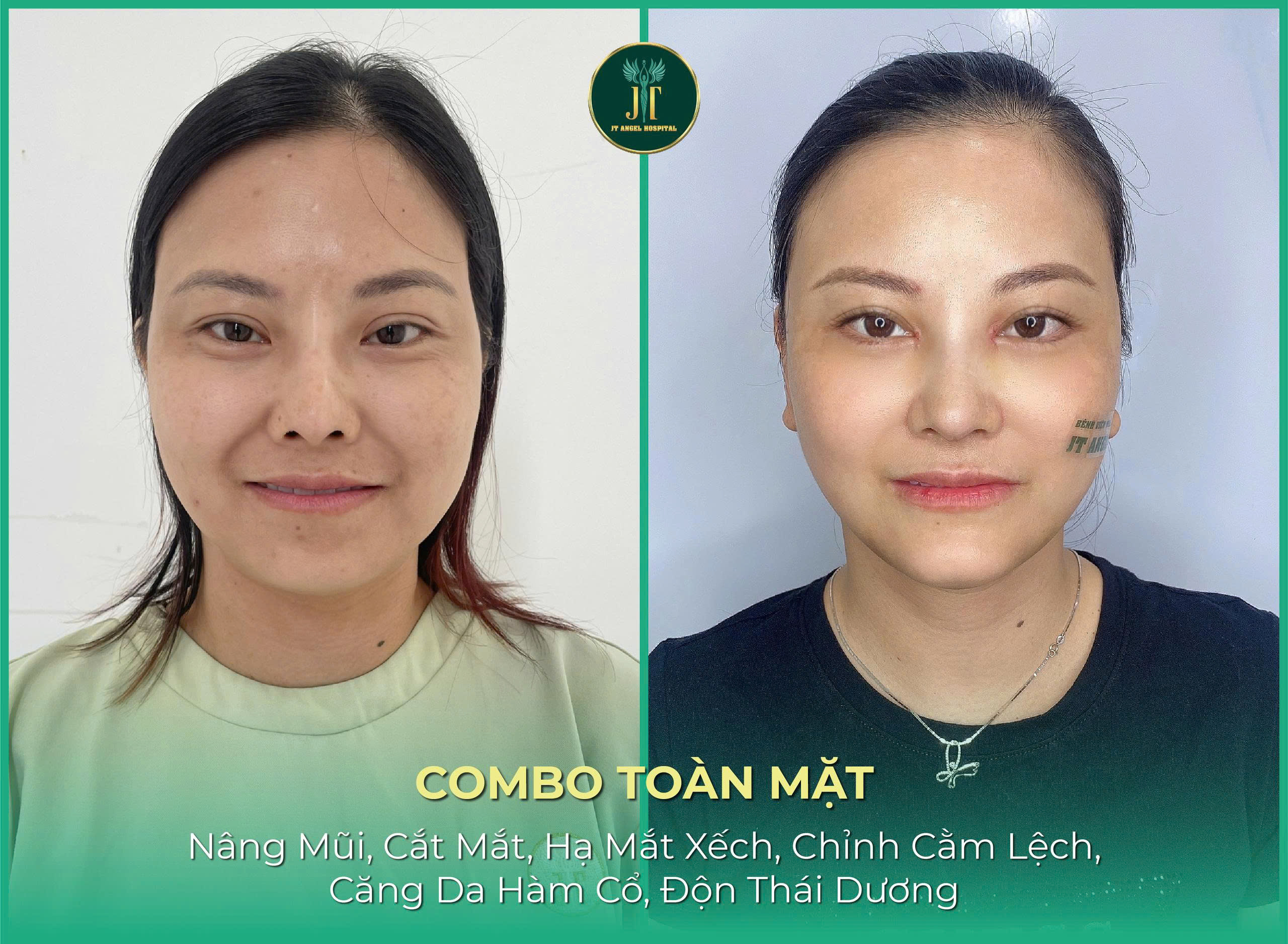 hinh-anh-truoc-sau-ha-xech-mat-su-thay-doi-than-thai-chi-sau-mot-ca-tieu-phau