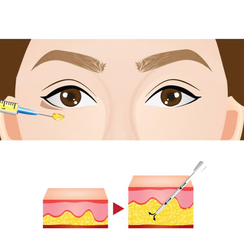 uu-va-nhuoc-diem-cua-phau-thuat-cay-mo-hoc-mat-co-nen-thuc-hien-khong