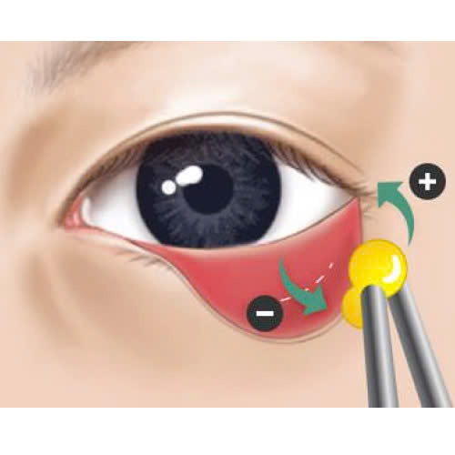 uu-va-nhuoc-diem-cua-phau-thuat-cay-mo-hoc-mat-co-nen-thuc-hien-khong