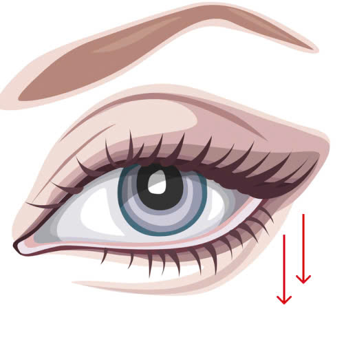 uu-diem-cua-phau-thuat-ha-xech-mat-la-gi-giai-phap-khac-phuc-anh-nhin-du-lay-lai-doi-mat-hien-hoa-diu-dang