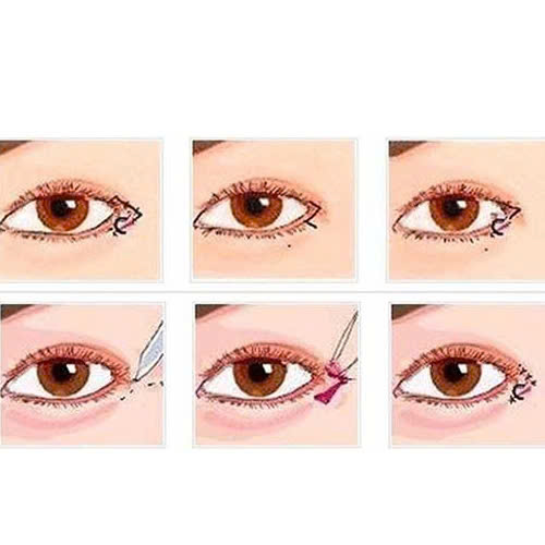 phau-thuat-ha-xech-mat-co-nguy-hiem-khong-nhung-dieu-ban-can-can-nhac-truoc-khi-quyet-dinh-lam-dep