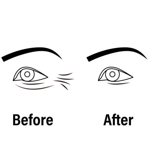 phuong-phap-cang-chi-duoi-mat-moi-nhat-nhung-dieu-can-biet-ve-phuong-phap-cang-chi-duoi-mat-moi-nhat-hien-nay