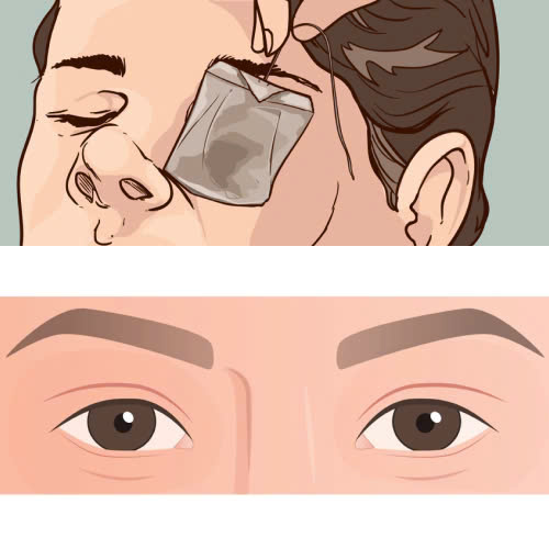 cach-cham-soc-sau-cay-mo-mi-mat-cuoi-giup-doi-mat-hoi-phuc-nhanh-va-dep-tu-nhien