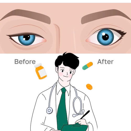 tim-hieu-chi-tiet-ve-nang-co-mi-mat-bi-sup-bam-sinh-va-nhung-dieu-can-biet
