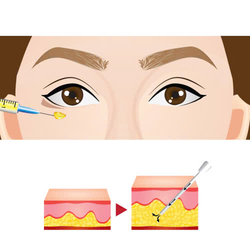 phau-thuat-cay-mo-mi-mat-cuoi-la-gi-uu-diem-noi-bat-cua-phuong-phap-nay-phu-hop-voi-ai