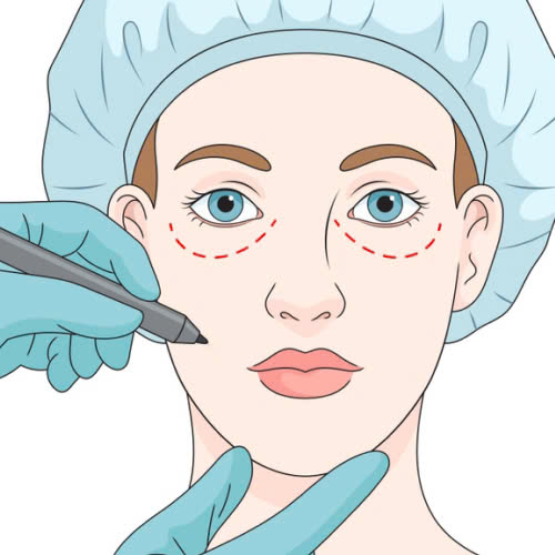 Quy trình cấy mỡ mí mắt cười cho nam diễn ra như thế nào?