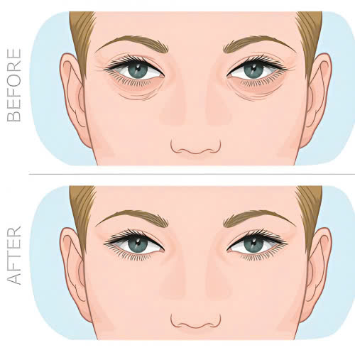 ha-bau-mat-bao-lau-thi-lanh-va-cach-cham-soc-de-hoi-phuc-nhanh-hieu-qua