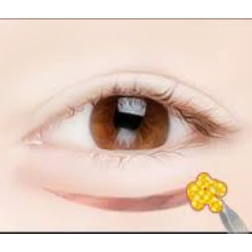 ha-bau-mat-bao-lau-thi-lanh-va-cach-cham-soc-de-hoi-phuc-nhanh-hieu-qua