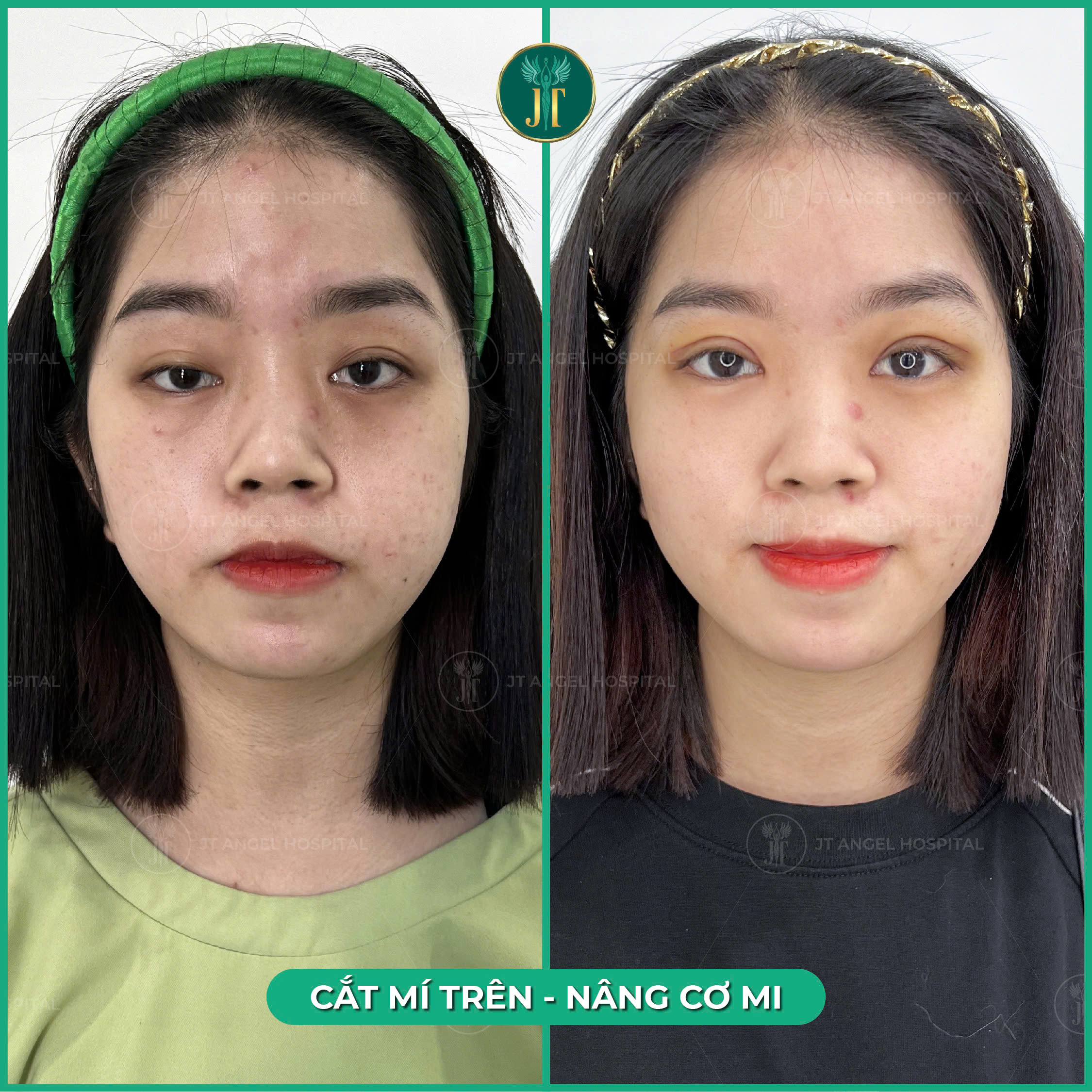 hinh-anh-truoc-sau-nang-co-mi-su-thay-doi-ro-ret-giup-doi-mat-tre-trung-hon