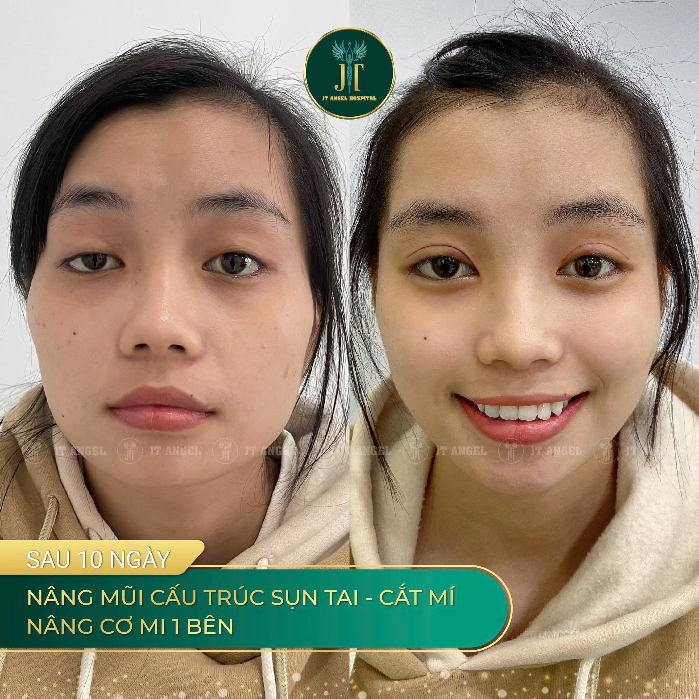 hinh-anh-truoc-sau-nang-co-mi-su-thay-doi-ro-ret-giup-doi-mat-tre-trung-hon