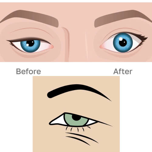 nang-co-mi-co-cai-thien-thi-luc-khong-va-hieu-qua-ra-sao