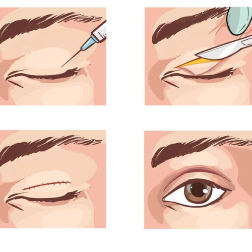 nang-co-mi-co-cai-thien-thi-luc-khong-va-hieu-qua-ra-sao