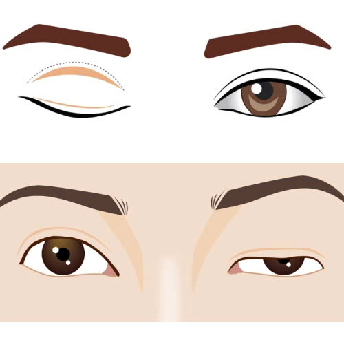 nang-co-mi-co-cai-thien-thi-luc-khong-va-hieu-qua-ra-sao