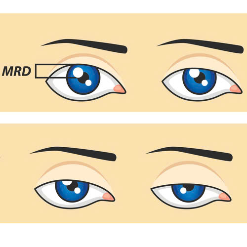nang-co-mi-co-tai-sup-lai-khong-mach-ban-cac-bi-quyet-ngan-ngua-tinh-trang-tai-sup-sau-nang-co-mi