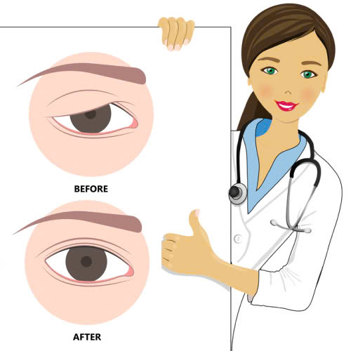 nang-co-mi-co-tai-sup-lai-khong-mach-ban-cac-bi-quyet-ngan-ngua-tinh-trang-tai-sup-sau-nang-co-mi
