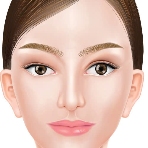 nang-co-mi-co-tai-sup-lai-khong-mach-ban-cac-bi-quyet-ngan-ngua-tinh-trang-tai-sup-sau-nang-co-mi