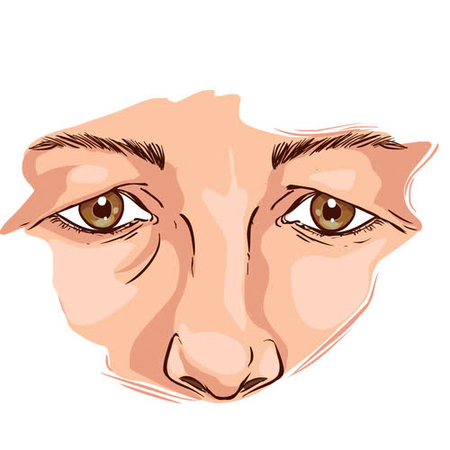 vi-sao-nen-lua-chon-nang-co-mi-mat-cho-nguoi-lon-tuoi-de-khac-phuc-da-chung-sup-mi