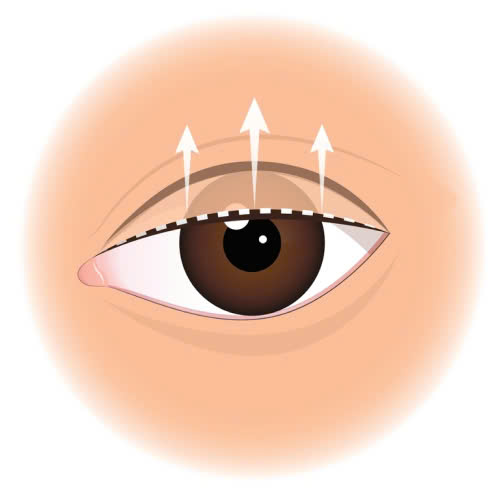 vi-sao-nen-lua-chon-nang-co-mi-mat-cho-nguoi-lon-tuoi-de-khac-phuc-da-chung-sup-mi