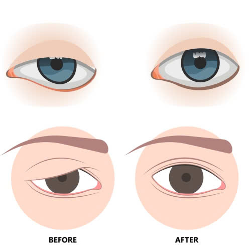 nang-co-mi-va-cat-mi-khac-nhau-the-nao-hieu-dung-de-chon-phuong-phap-phu-hop-cho-doi-mat-dep-tu-nhien