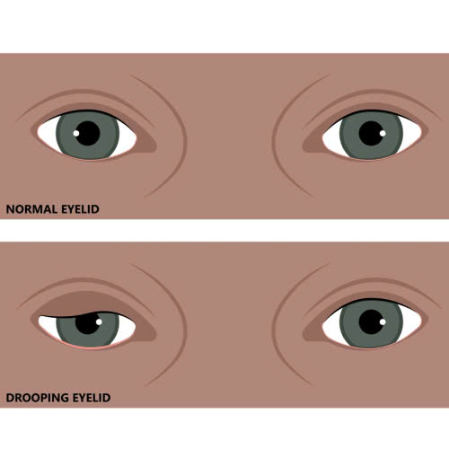 nang-co-mi-va-cat-mi-khac-nhau-the-nao-hieu-dung-de-chon-phuong-phap-phu-hop-cho-doi-mat-dep-tu-nhien