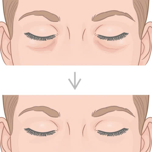 phau-thuat-ha-bau-mat-la-gi-giai-phap-tre-hoa-giup-doi-mat-tuoi-sang-tu-nhien-hieu-qua-lau-dai