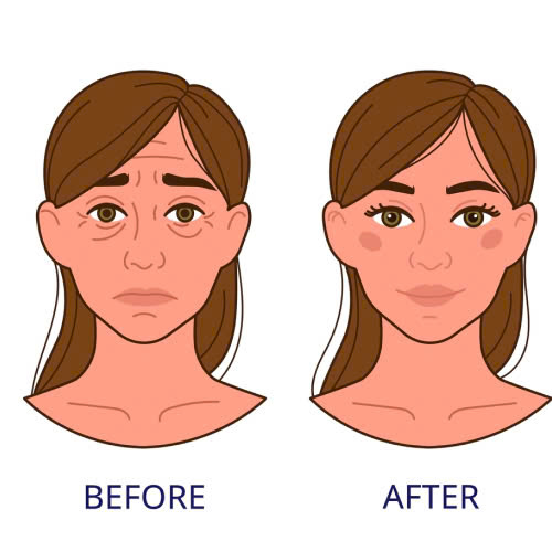 phau-thuat-ha-bau-mat-la-gi-giai-phap-tre-hoa-giup-doi-mat-tuoi-sang-tu-nhien-hieu-qua-lau-dai