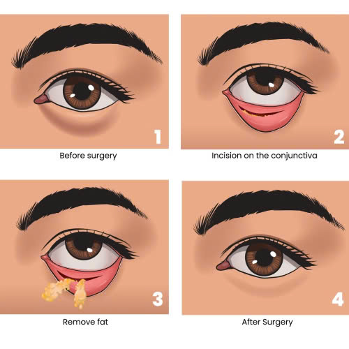 phau-thuat-ha-bau-mat-bao-lau-thi-on-dinh-cung-tim-hieu-bi-quyet-giup-mat-mau-on-dinh-va-rut-ngan-thoi-gian-hoi-phuc
