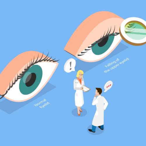 phau-thuat-nang-co-mi-giai-phap-hieu-qua-cho-doi-mat-tuoi-tre-tu-tin