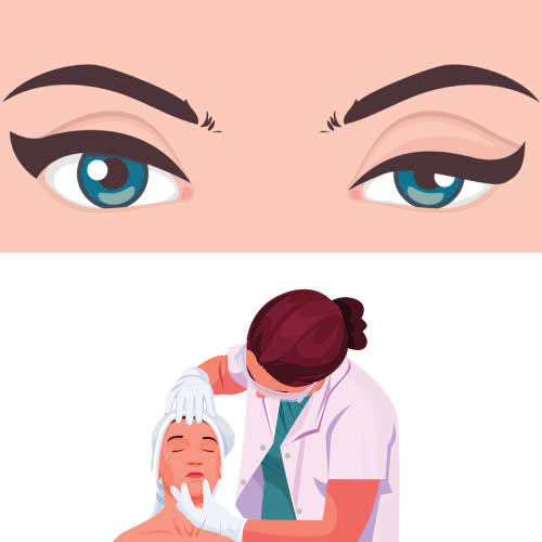 phau-thuat-nang-co-mi-giai-phap-hieu-qua-cho-doi-mat-tuoi-tre-tu-tin