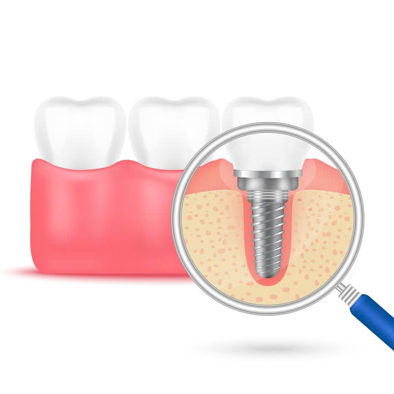 cung-tim-hieu-ve-cam-tru-implant-han-quoc-va-nhung-luu-y-khi-thuc-hien-dich-vu-nay