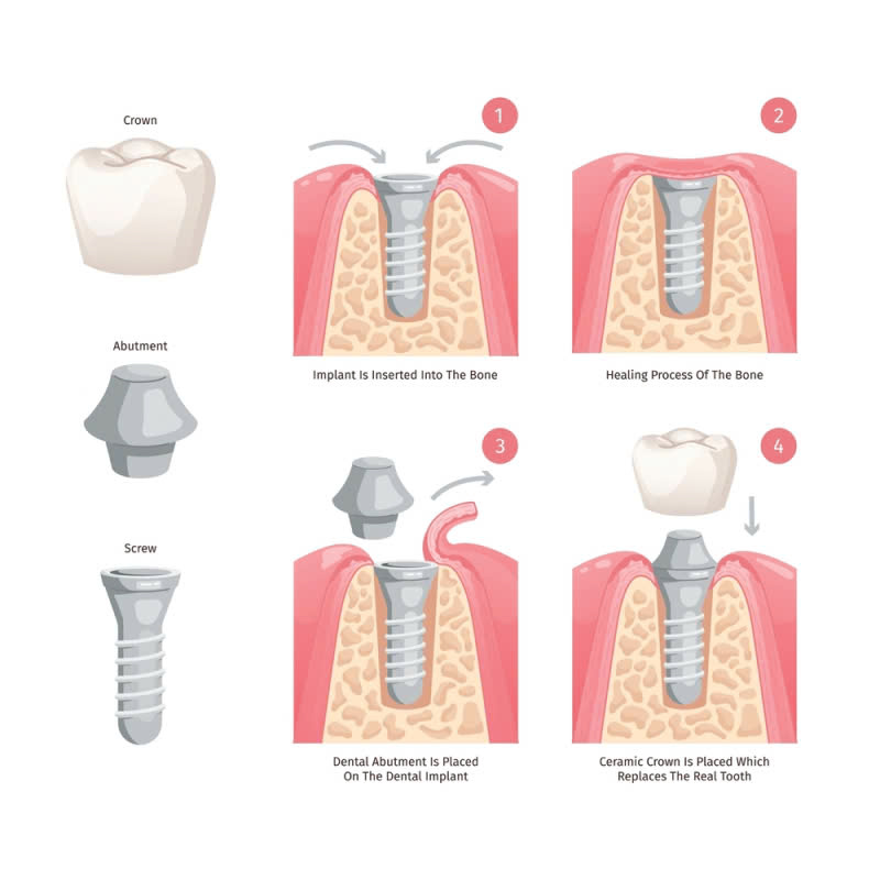 cung-tim-hieu-ve-cam-tru-implant-han-quoc-va-nhung-luu-y-khi-thuc-hien-dich-vu-nay