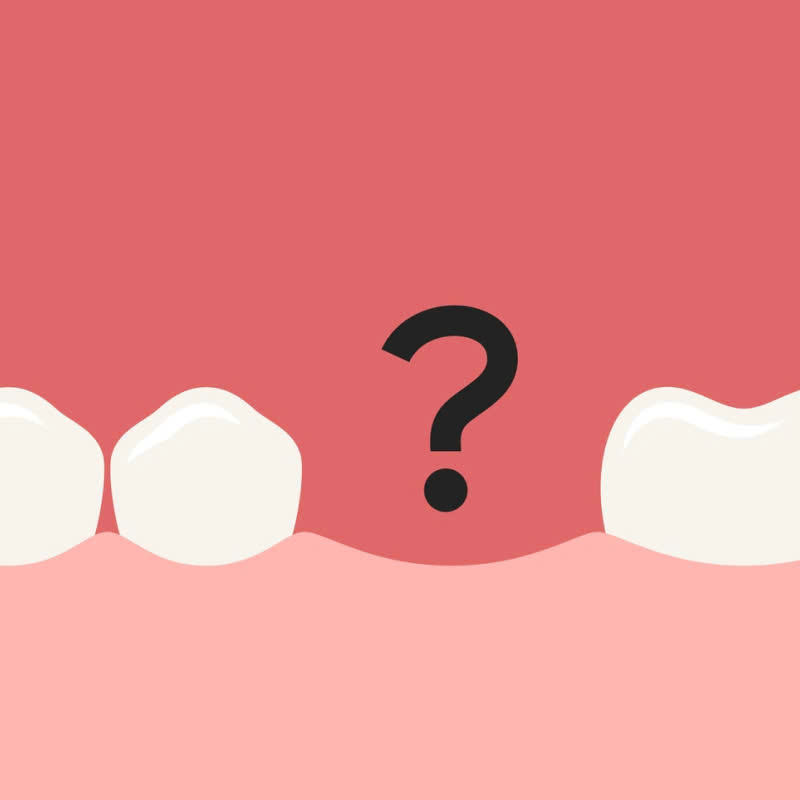 cung-tim-hieu-ve-cam-tru-implant-han-quoc-va-nhung-luu-y-khi-thuc-hien-dich-vu-nay