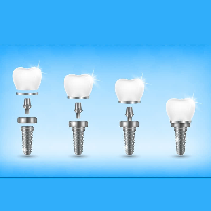 cung-tim-hieu-ve-cam-tru-implant-han-quoc-va-nhung-luu-y-khi-thuc-hien-dich-vu-nay