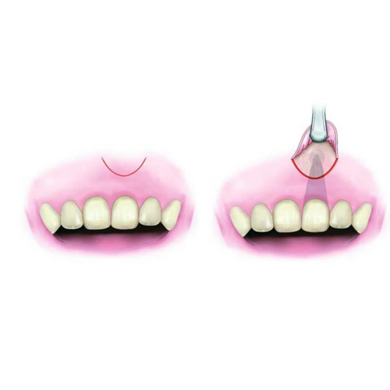 cat-chop-co-dau-khong-phuong-phap-nay-se-ap-dung-vao-nhung-truong-hop-nao