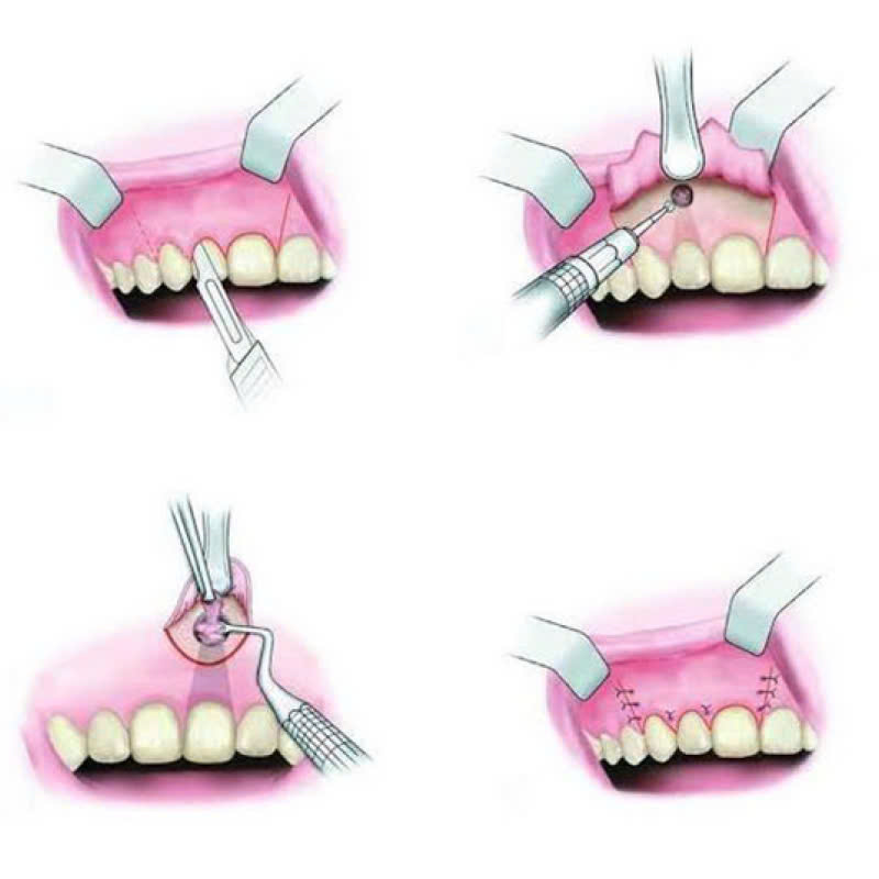 cat-chop-co-dau-khong-phuong-phap-nay-se-ap-dung-vao-nhung-truong-hop-nao