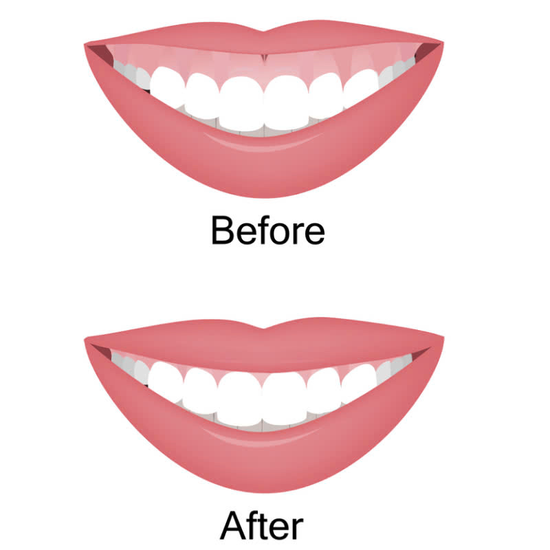 cat-loi-co-anh-huong-toi-suc-khoe-rang-mieng-khong-nhung-doi-tuong-nao-phu-hop-voi-phuong-phap-nay