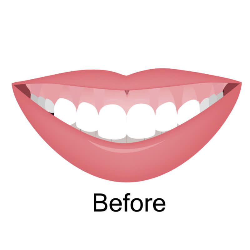 cat-loi-co-anh-huong-toi-suc-khoe-rang-mieng-khong-nhung-doi-tuong-nao-phu-hop-voi-phuong-phap-nay