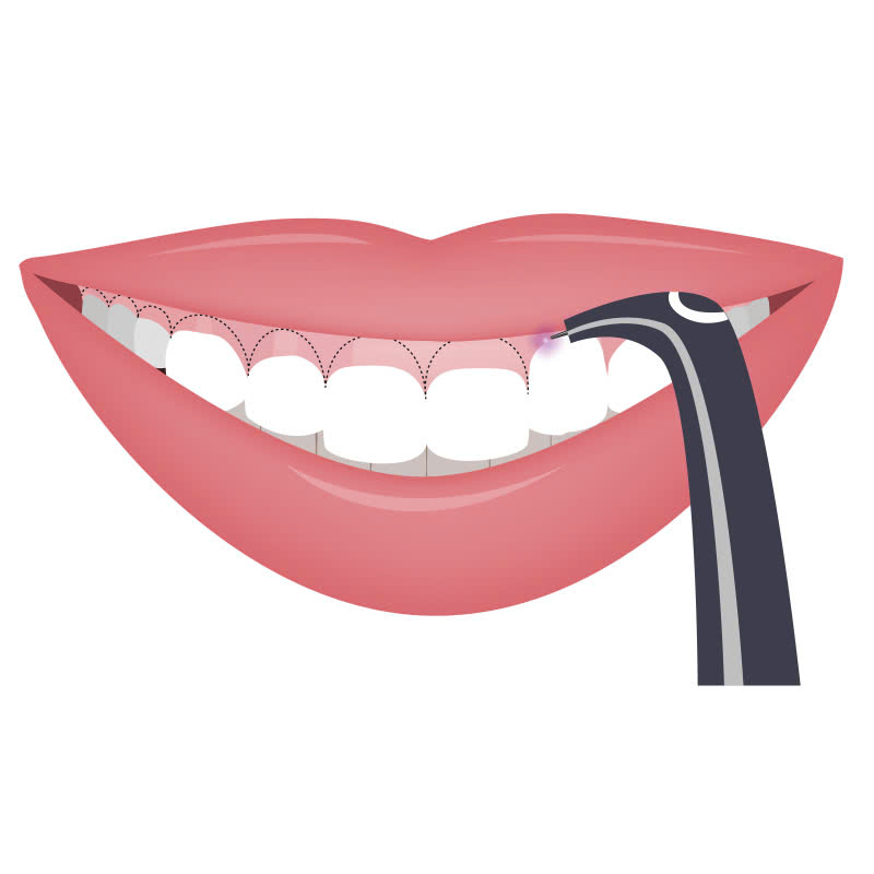 cat-loi-co-anh-huong-toi-suc-khoe-rang-mieng-khong-nhung-doi-tuong-nao-phu-hop-voi-phuong-phap-nay